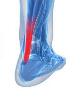 tendinitis